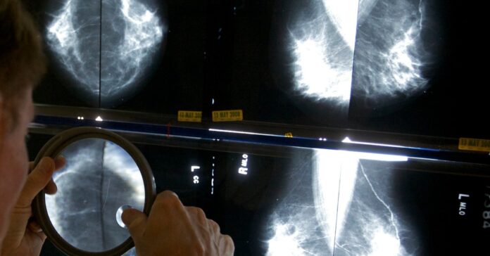 Fda Requires New Info On Breast Density With All Mammograms