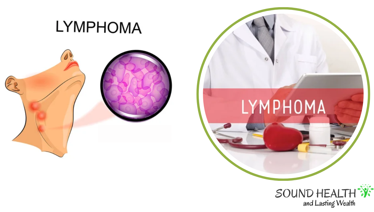 Final Stages Of Mantle Cell Lymphoma Prognosis Treatment Options And